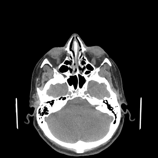 Bisphosphonate-related osteonecrosis of the jaw (Radiopaedia 71324-81642 non-contrast 168).jpg