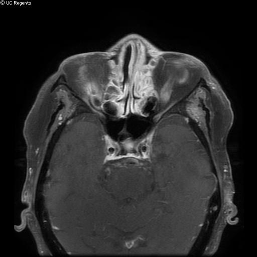 File:Bisphosphonate-related osteonecrosis of the maxilla (Radiopaedia 51367-57101 Axial T1 C+ fat sat 33).jpg