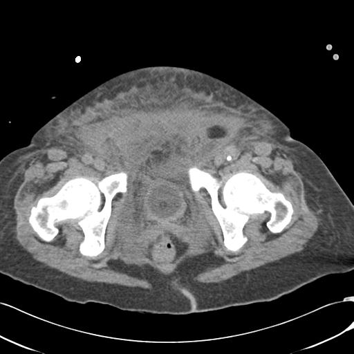 Bladder rupture post renal biopsy (Radiopaedia 30863-31572 Axial non-contrast 84).jpg