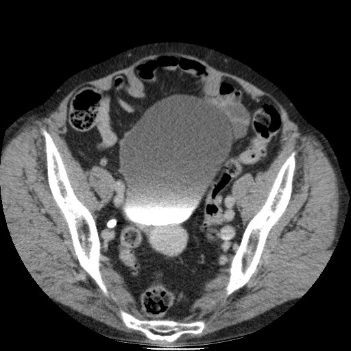Bladder tumor detected on trauma CT (Radiopaedia 51809-57609 C 111).jpg