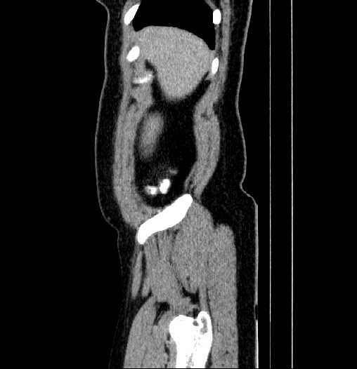 Blind-ending branch of a bifid ureter (Radiopaedia 61159-69048 E 1).jpg