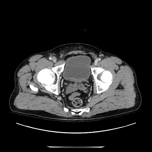 Blunt abdominal trauma with solid organ and musculoskelatal injury with active extravasation (Radiopaedia 68364-77895 A 145).jpg