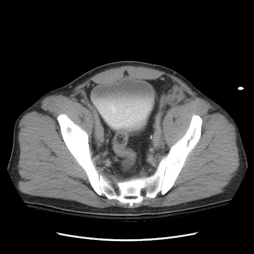Blunt abdominal trauma with solid organ and musculoskelatal injury with active extravasation (Radiopaedia 68364-77895 Axial C+ delayed 116).jpg