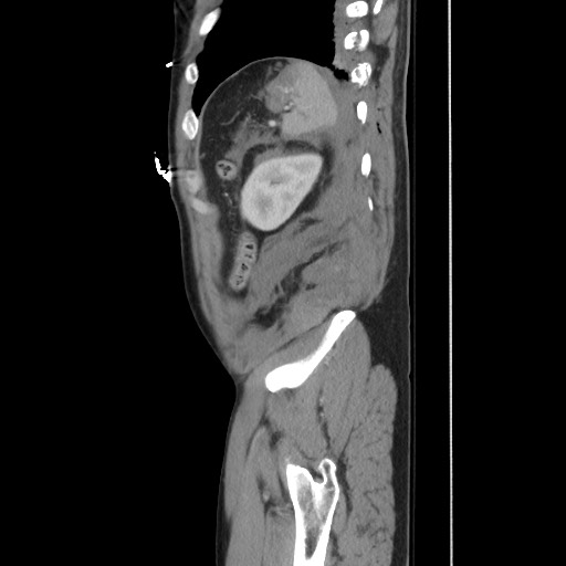 Blunt abdominal trauma with solid organ and musculoskelatal injury with active extravasation (Radiopaedia 68364-77895 C 119).jpg