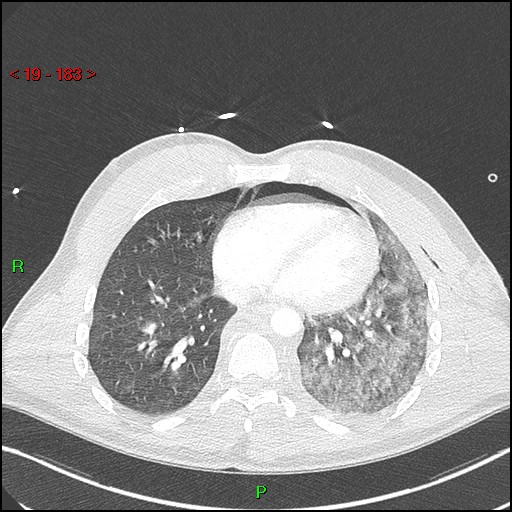 Blunt thoracic trauma (Radiopaedia 73454-84221 Axial lung window 67).jpg
