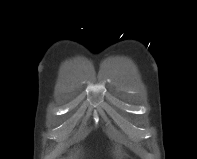 Boerhaave syndrome (Radiopaedia 39382-41660 C 11).png
