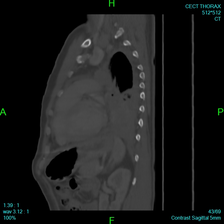 Bone metastases from lung carcinoma (Radiopaedia 54703-60937 Sagittal bone window 43).jpg