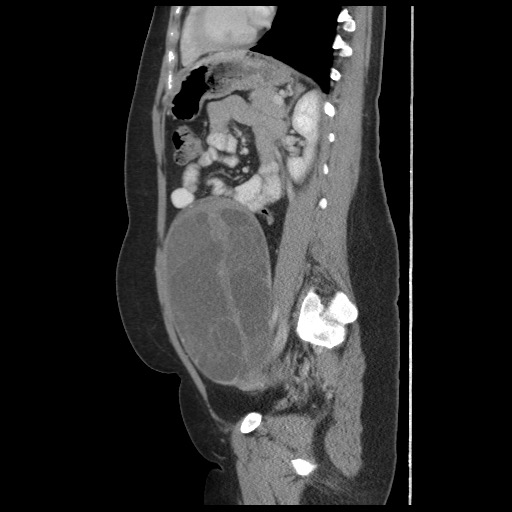 Borderline mucinous tumor (ovary) (Radiopaedia 78228-90808 B 43).jpg