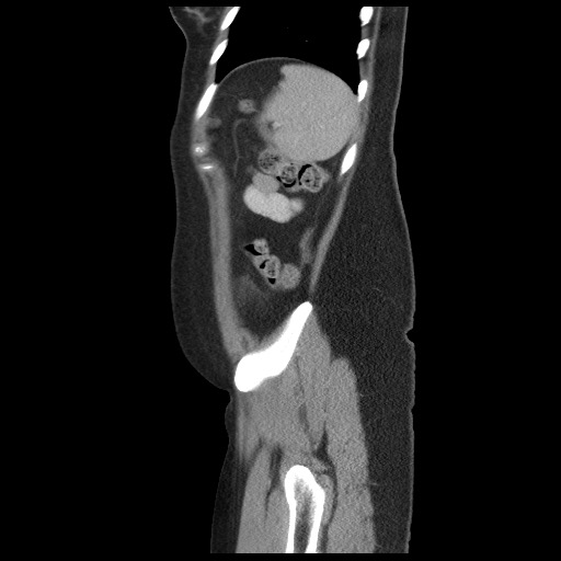 File:Borderline mucinous tumor (ovary) (Radiopaedia 78228-90808 B 56).jpg