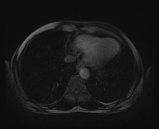 File:Bouveret syndrome (Radiopaedia 61017-68856 Axial T1 C+ fat sat 2).jpg