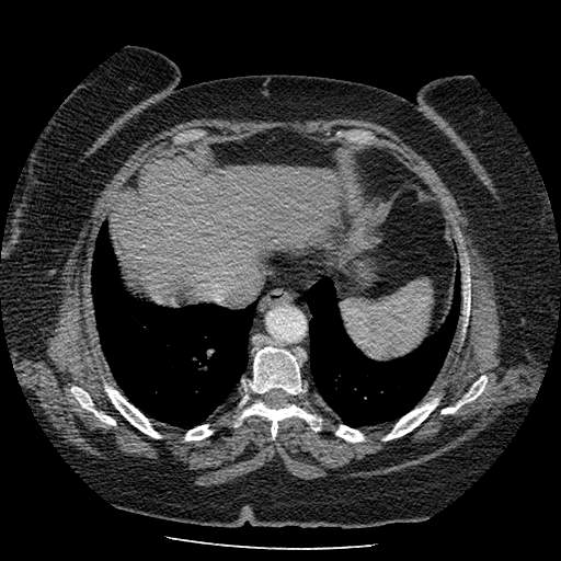 Bovine aortic arch - right internal mammary vein drains into the superior vena cava (Radiopaedia 63296-71875 A 124).jpg