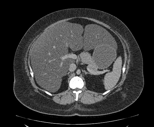 File:Bowel and splenic infarcts in acute lymphocytic leukemia (Radiopaedia 61055-68913 A 47).jpg