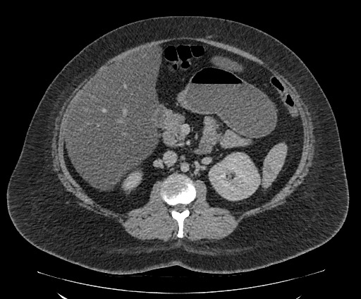 Bowel and splenic infarcts in acute lymphocytic leukemia (Radiopaedia 61055-68913 A 57).jpg