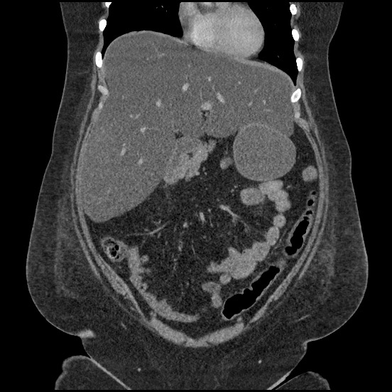 Bowel and splenic infarcts in acute lymphocytic leukemia (Radiopaedia 61055-68913 B 24).jpg