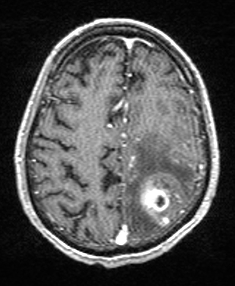 Brain abscess with dual rim sign (Radiopaedia 87566-103938 Axial T1 C+ 120).jpg