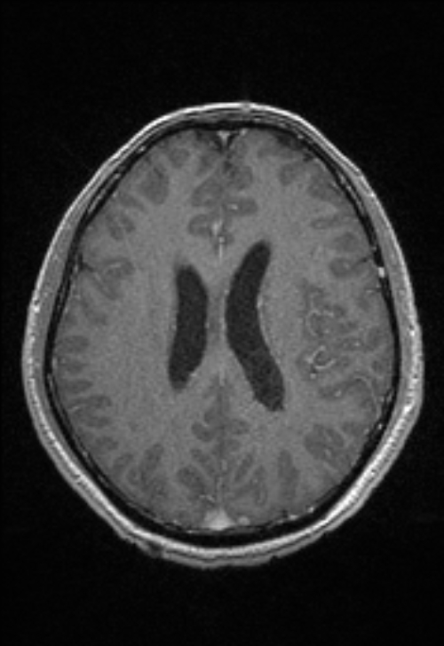 Brain abscess with ventriculitis (Radiopaedia 85703-101495 Axial T1 C+ 114).jpg