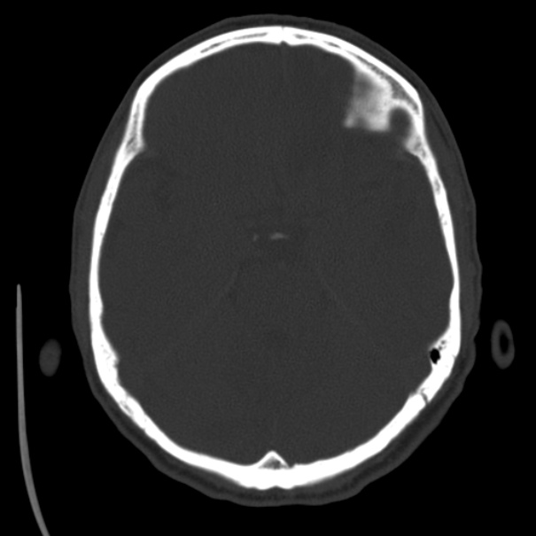 Brain metastases from lung cancer (Radiopaedia 24480-24781 Axial bone window 16).jpg