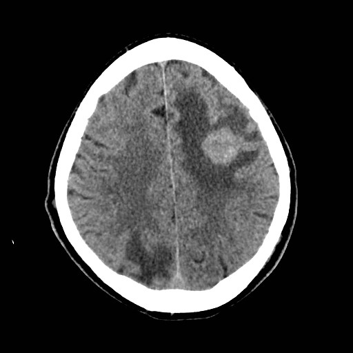 File:Brain metastases from lung cancer (Radiopaedia 83839-99027 Axial non-contrast 26).jpg