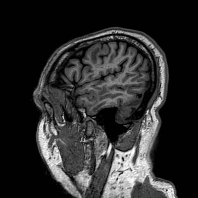 Brain metastases from lung cancer (Radiopaedia 83839-99028 Sagittal T1 112).jpg