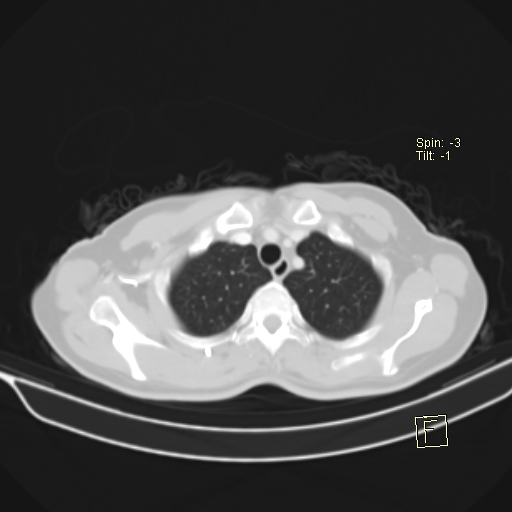 File:Brain metastasis as initial presentation of non-small cell lung cancer (Radiopaedia 65122-74127 Axial lung window 9).jpg