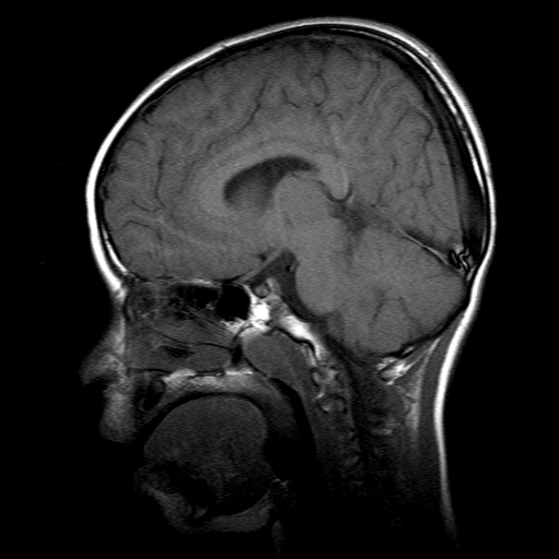File:Brainstem ganglioglioma (Radiopaedia 10763-11224 Sagittal T1 11).jpg