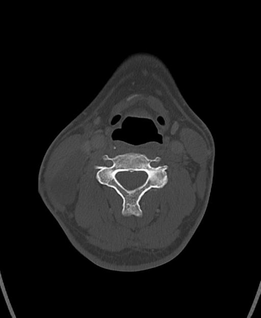 Branchial cleft cyst (Radiopaedia 31167-31875 Axial bone window 39).jpg