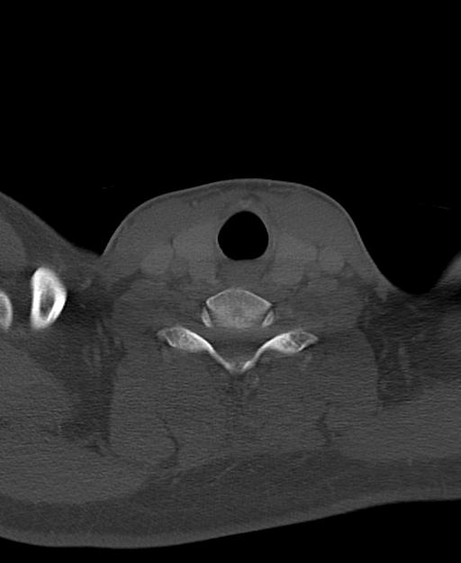 Branchial cleft cyst (Radiopaedia 31167-31875 Axial bone window 56).jpg