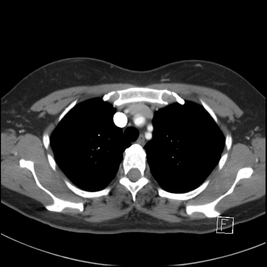Breast metastases from renal cell cancer (Radiopaedia 79220-92225 A 23).jpg