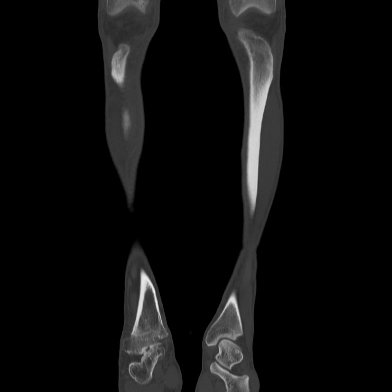 Brodie abscess - tibia (Radiopaedia 66028-75204 Coronal bone window 2).jpg