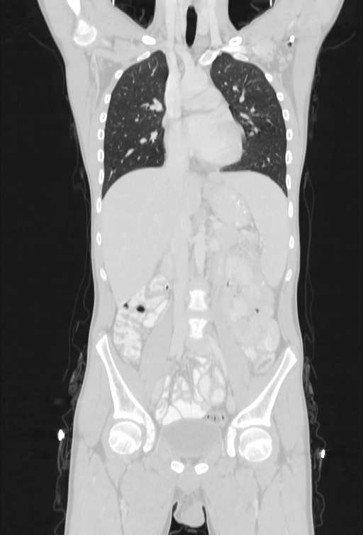 Bronchial carcinoid tumor (Radiopaedia 57187-64090 Coronal lung window 41).jpg