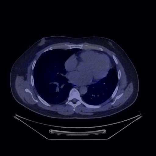 Bronchial carcinoid tumor (Radiopaedia 67377-76765 68Ga-DOTATATE PET-CT 34).jpg