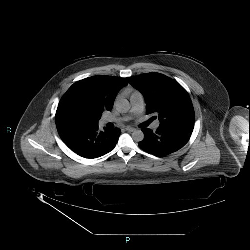 Bronchial carcinoid tumor (Radiopaedia 78272-90870 Axial non-contrast 48).jpg