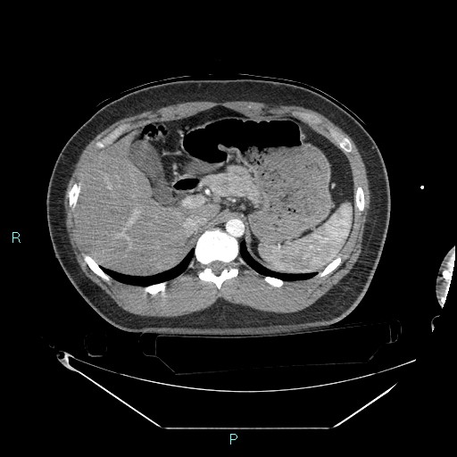 Bronchial carcinoid tumor (Radiopaedia 78272-90870 B 120).jpg