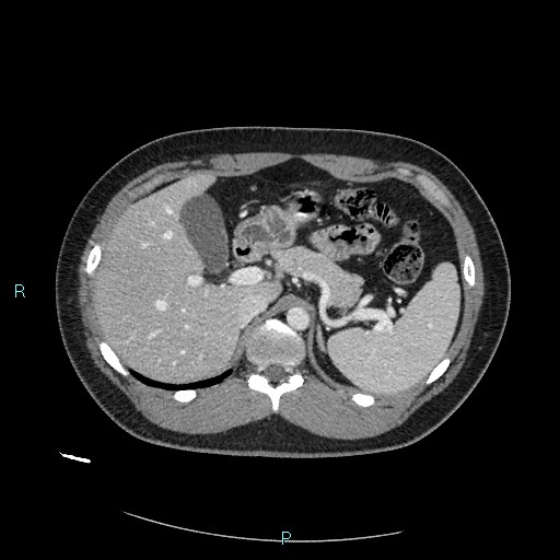 Bronchial carcinoid tumor (Radiopaedia 78272-90875 A 98).jpg