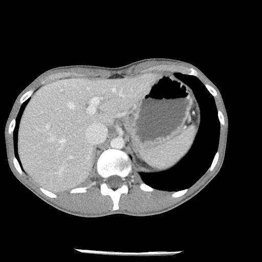Bronchial carcinoid tumor causing right lower lobe collapse (Radiopaedia 83495-98594 A 52).jpg