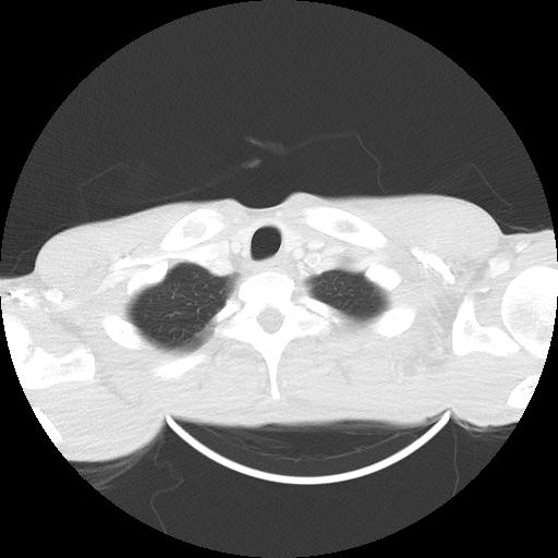 Bronchial carcinoid tumor causing right lower lobe collapse (Radiopaedia 83495-98594 Axial lung window 1).jpg