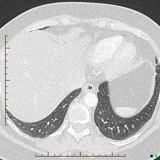 File:Bronchial diverticula (Radiopaedia 79512-92676 Axial lung window 172).jpg
