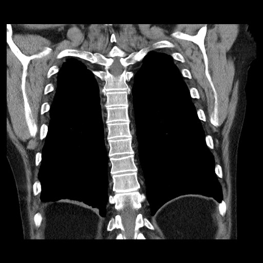 Bronchial stenosis - lung transplant (Radiopaedia 73133-83848 Coronal non-contrast 50).jpg