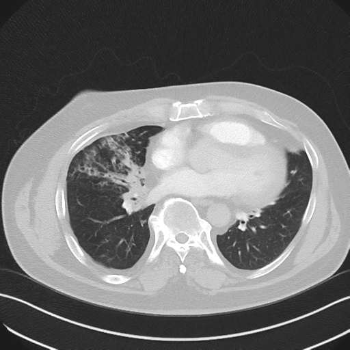 Bronchiectasis (Radiopaedia 39385-41666 Axial lung window 39).png