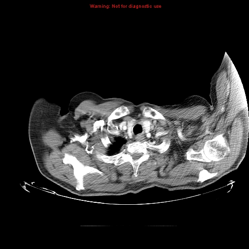 File:Bronchioloalveolar carcinoma (Radiopaedia 9272-9955 A 1).jpg