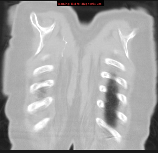 Bronchoalveolar carcinoma (BAC) (Radiopaedia 13436-13392 Coronal lung window 57).jpg