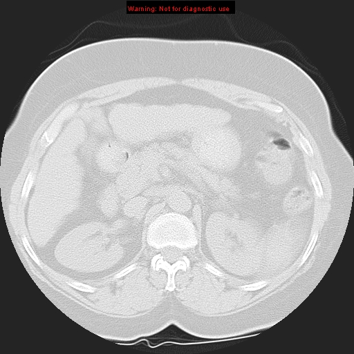 Bronchoalveolar carcinoma (Radiopaedia 13224-13233 Axial lung window 54).jpg