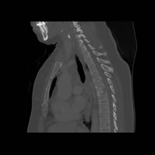 File:Bronchogenic carcinoma (Radiopaedia 73497-84262 Sagittal bone window 80).jpg