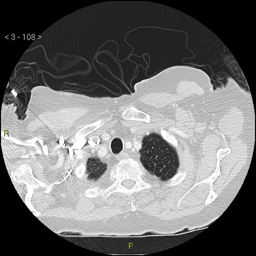 File:Bronchogenic carcinoma as an incidental finding (Radiopaedia 16453-16130 Axial lung window 108).jpg