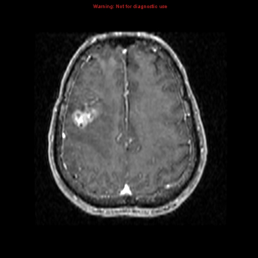 File:Bronchogenic carcinoma brain metastasis (Radiopaedia 9286-9969 Axial T1 C+ 17).jpg