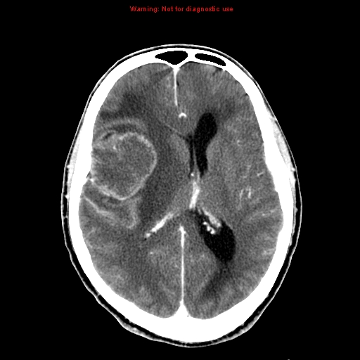 File:Bronchogenic carcinoma brain metastasis (Radiopaedia 9286-9970 B 16).jpg