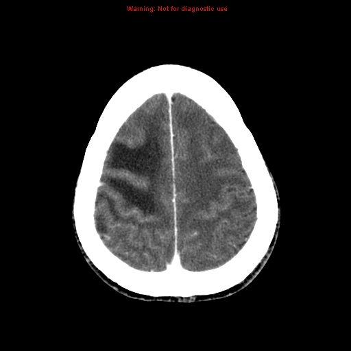 File:Bronchogenic carcinoma brain metastasis (Radiopaedia 9286-9970 B 24).jpg