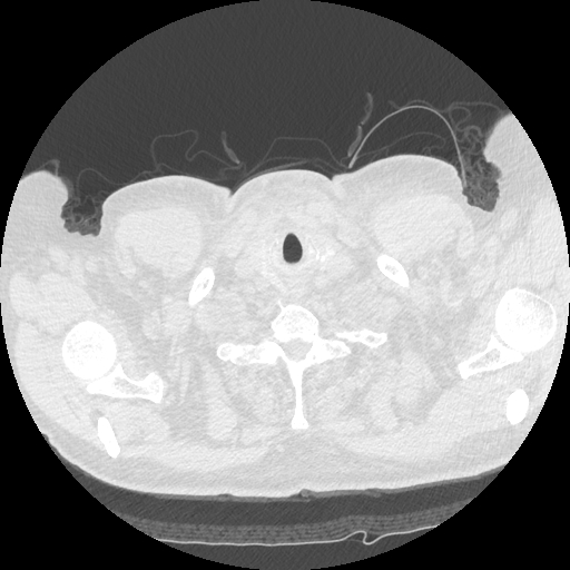 Bronchogenic carcinoma with metastatic lymphadenopathy (Radiopaedia 37671-39569 Axial lung window 2).jpg