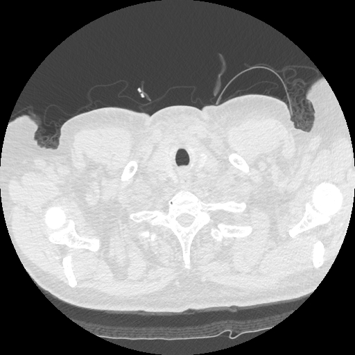 Bronchogenic carcinoma with metastatic lymphadenopathy (Radiopaedia 37671-39569 Axial lung window 3).jpg