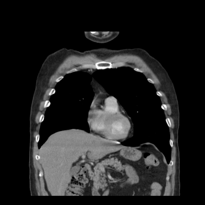 Bronchogenic carcinoma with upper lobe collapse (Radiopaedia 29297-29726 D 20).jpg